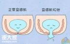 盆底肌：女性健康不可或缺的守护者