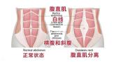 产后恢复难题：腹直肌分离如何有效应对？