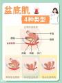 产后妈妈必存！盆底肌问题分型修复宝典